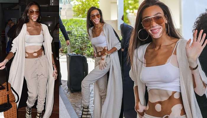 Модель с пятнистой кожей отказалась от бюстгальтера