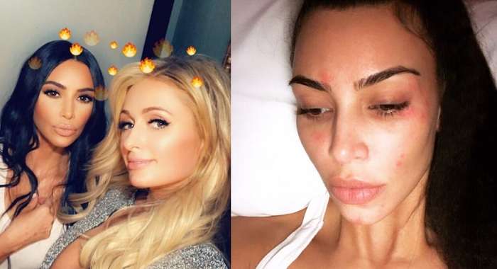 После вечеринки с Пэрис Хилтон известная звезда показала лицо с псориазом