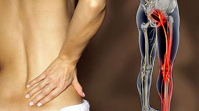 ДОБРОБУТ: Эффективное лечение радикулита