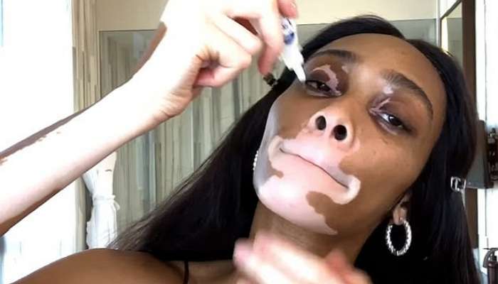 Винни Харлоу борется с пятнистым лицом с помощью капель для глаз